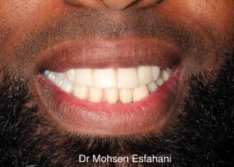 straight teeth