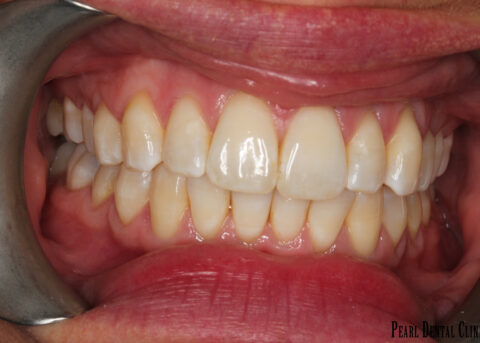 Invisalign anterior after