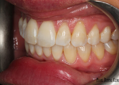 Invisalign buccal left after