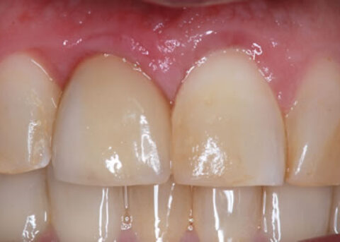 Crown implant_gum contouring