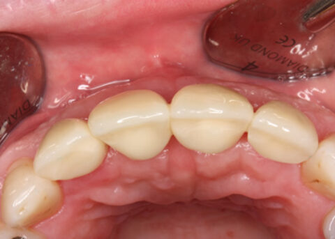 Before After Bone Augmentation - Gum in shape after two months