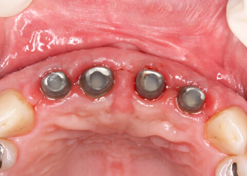 Before After Bone Augmentation - Permanent titanium abutments are screwed