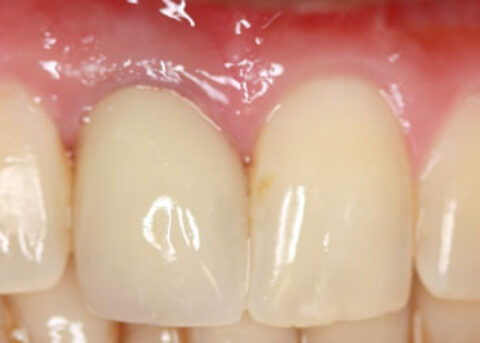 Before After Missing Front Tooth - Temporary crown placed