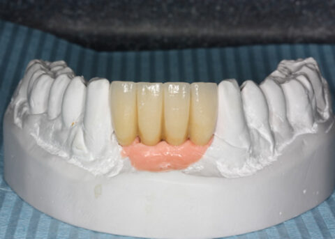 Missing Lower Front Teeth - Lower arch planning model for four teeth