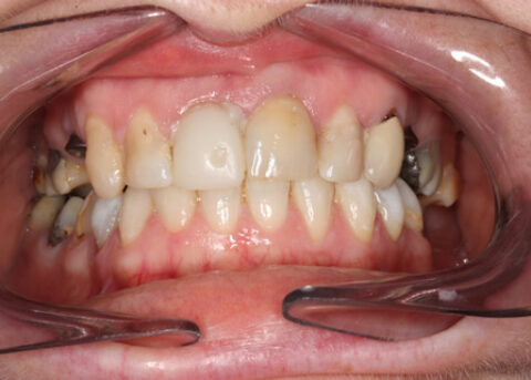 Before After Missing Premolars - Two missing upper premolars