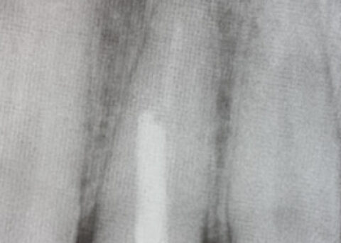 Broken down root X-ray