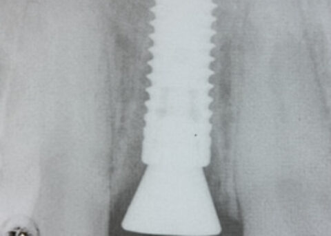 Straumann implant as root extraction
