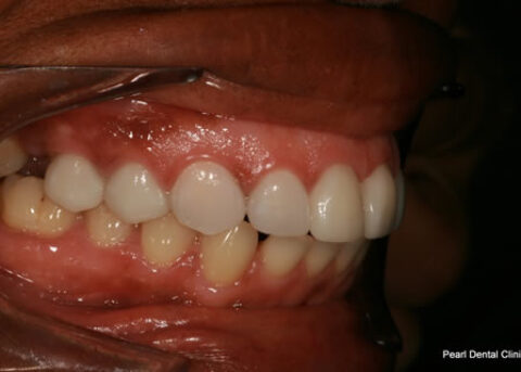 Improved Smile After - Right full arch Emax crown_veneers teeth