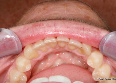 Invisalign After - Bottom arch teeth