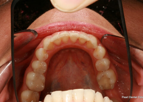 Invisalign After - Full bottom arch teeth