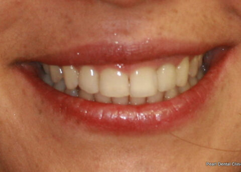 Invisalign After - Full smile