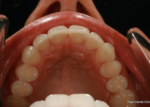 Invisalign After - Full top arch teeth