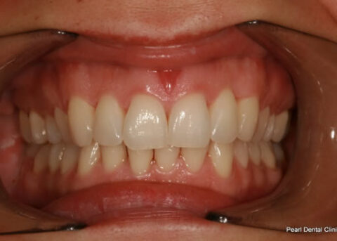 Invisalign After - Full top_bottom arches teeth