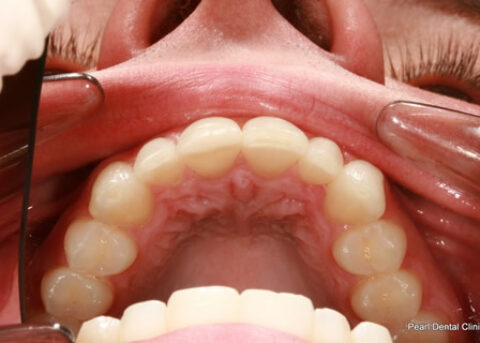 Invisalign After - Full upper arch teeth