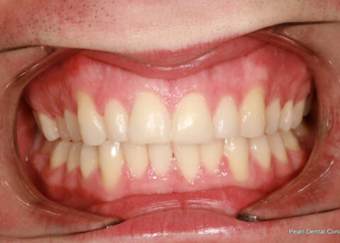 Invisalign After - teeth whitening_teeth bleaching after