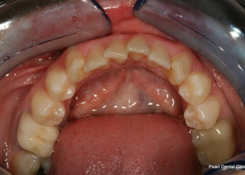 Invisalign Before - Bottom arch teeth