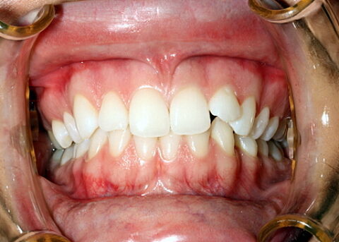 Invisalign Before - Full top_bottom arches teeth