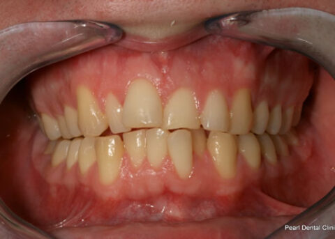 Invisalign Before - Full upper_lower arches teeth