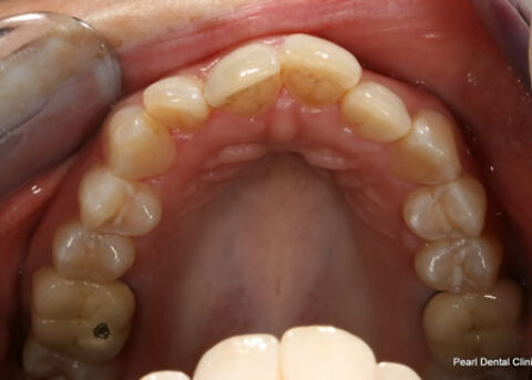 Invisalign Before - Top arch teeth