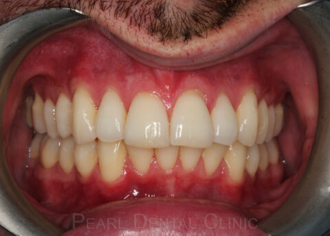 Invisalign anterior after