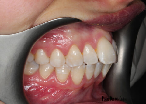 Invisalign buccal right before