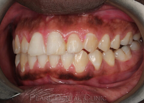 Invisalign_buccal_left after