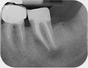 completed root canal treatment