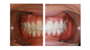 A Guide To Teeth Veneers