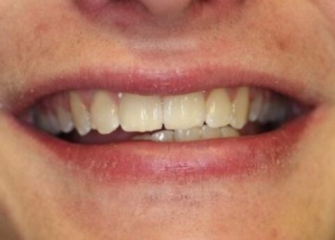 Six Month Smiles After Gallery - Teeth Straightened