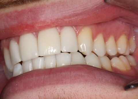 Smile Makeover After - Left full arch Emax veneers teeth