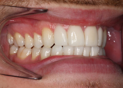 Smile Makeover After - Right full arch Emax veneers teeth