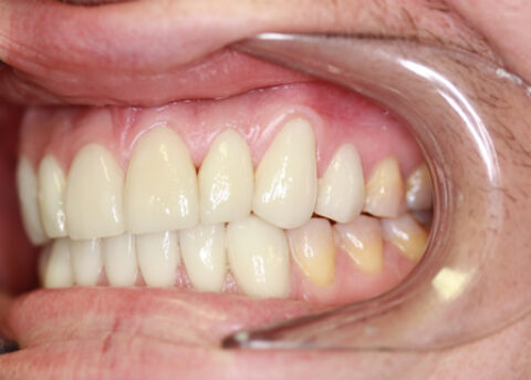 Stain Teeth Treatment After - Left full top_bottom arch teeth Emax veneer