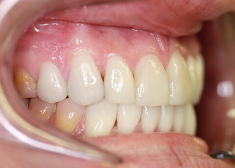 Stain Teeth Treatment After - Right full top_bottom arch teeth Emax veneer
