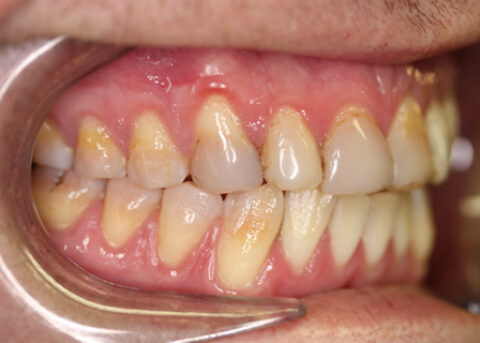 Stain Teeth Treatment Before - Left full upper_lower arch teeth stain