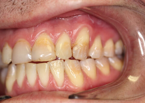 Stain Teeth Treatment Before - Right full upper_lower arch teeth stain