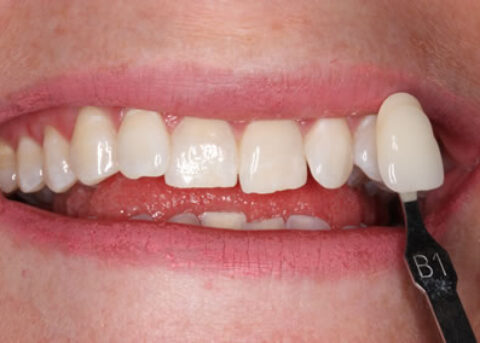 Teeth Whitening After - Teeth whitening