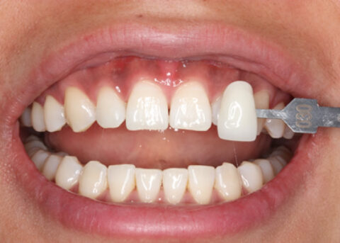 Teeth Whitening After - Teeth whitening