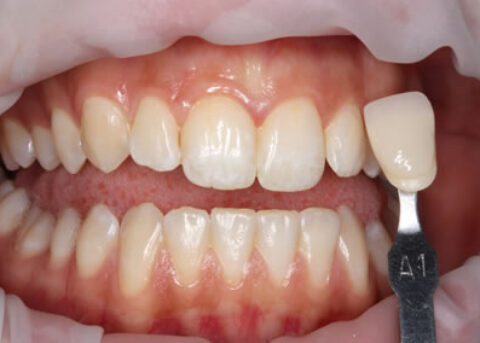 Teeth Whitening Before - Teeth whitening