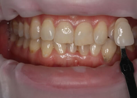 Teeth Whitening Before - Teeth whitening