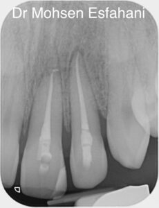 root filled front tooth