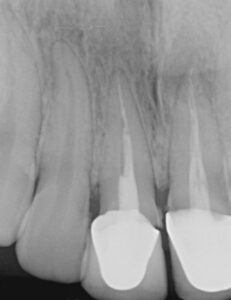 before root canal retreatment