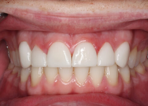 Worn_Chipped Teeth After - Full arch upper_Bottom