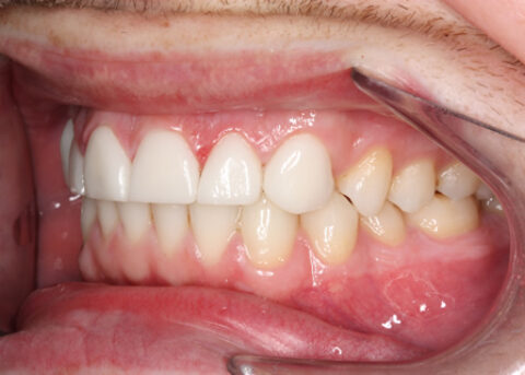 Worn_Chipped Teeth After - Left full arch Emax Veneers teeth