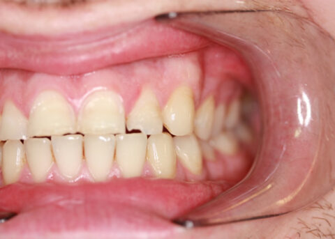Worn_Chipped Teeth Before - Left full arch upper_Bottom