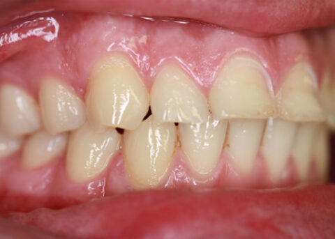 Worn_Chipped Teeth Before - Right full arch upper_Bottom