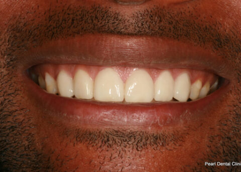 Worn_Discoloured Teeth After - Full smile makeover_Emax veneer