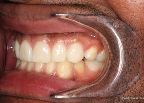 Worn_Discoloured Teeth After - Left full arch smile makeover_Emax veneer