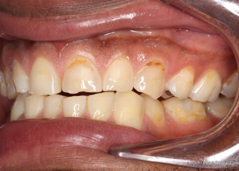 Worn_Discoloured Teeth Before - Left full arch worn_discoloured teeth