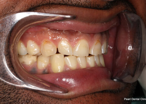 Worn_Discoloured Teeth Before - Right full arch worn_discoloured teeth
