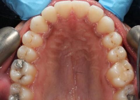 after invisalign upper arch